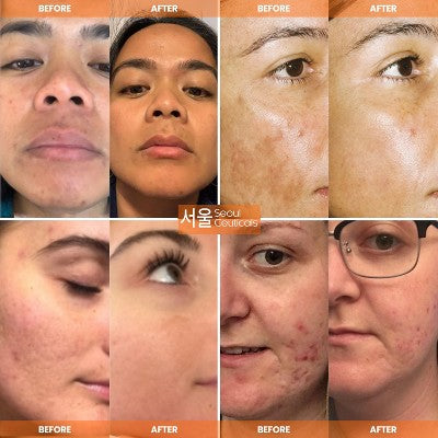 Seoul Ceuticals Korean Skin Care K Beauty 20% Vitamin C Hyaluronic Acid Serum + CE Ferulic Acid Provides Potent 1oz - Imperfect Box